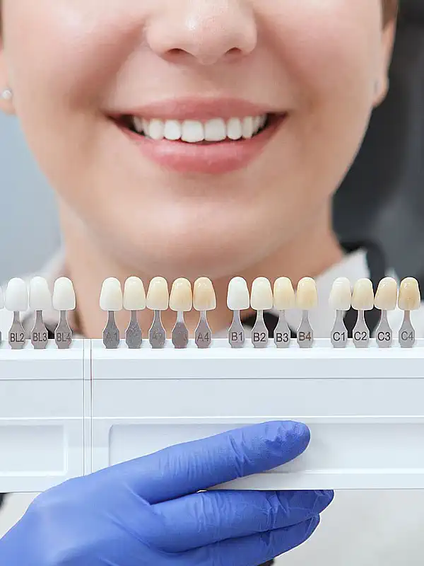 Dental Veneers (Hollywood Smile)